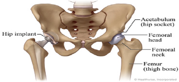 Total Hip Replacement